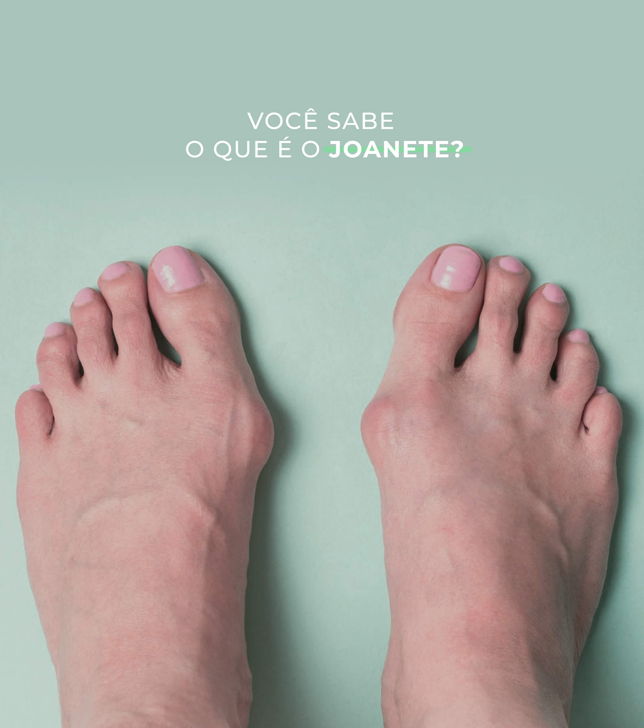 DÚVIDAS COMUNS SOBRE JOANETE (HÁLUX VALGO)